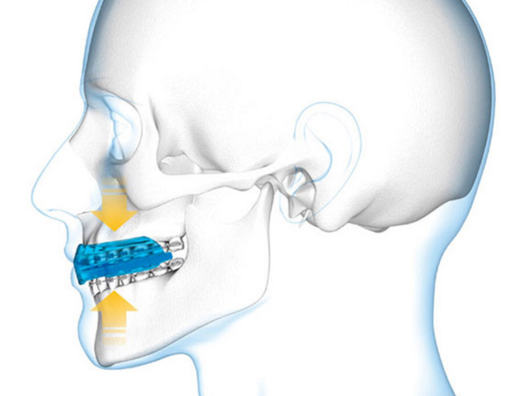 Importance of Mouth guards during Sporting Events