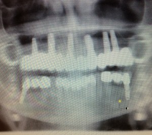 dental Implant 2