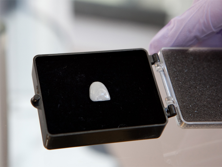 Benefits of Dental Veneers