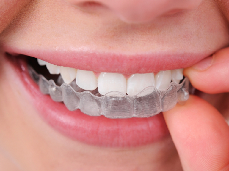 Invisalign Benefits